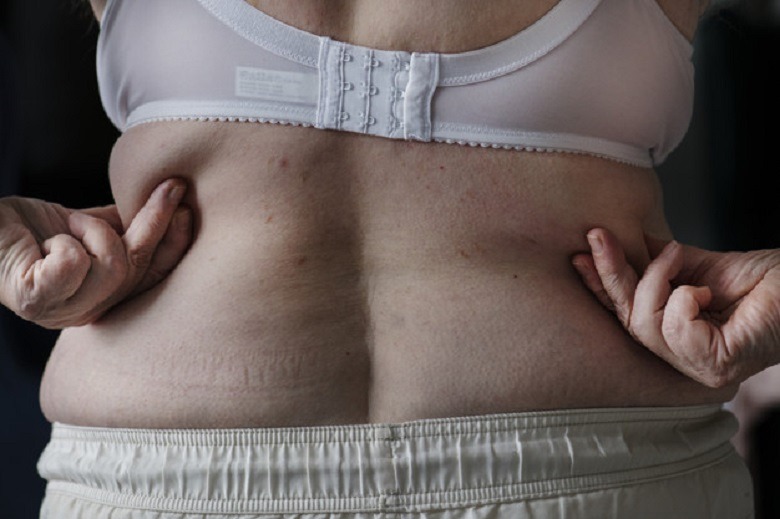 Obesidade: Sua microbiota intestinal pode determinar seu ganho de peso